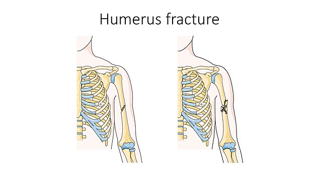 How does Fracture look like